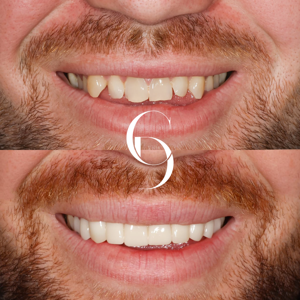 Mason's Veneers Makeover In Cosmetique Dental™