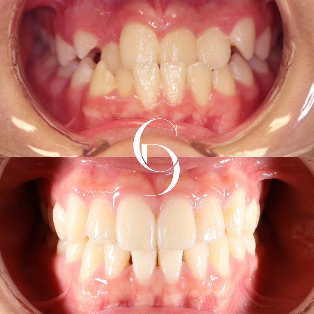 Matilda Orthodontics Makeover In Cosmetique Dental™ Matilda's Orthodontics Makeover In Cosmetique Dental™