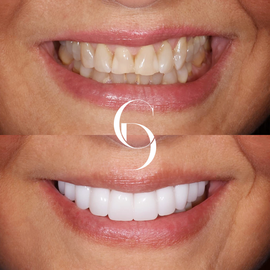 Maya's Veneers Makeover In Cosmetique Dental™