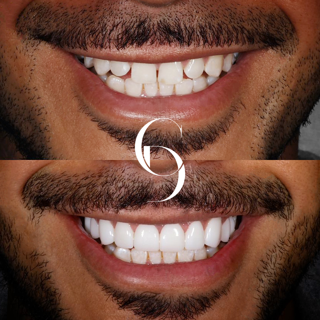 Mckenzie's Veneers Makeover In Cosmetique Dental™