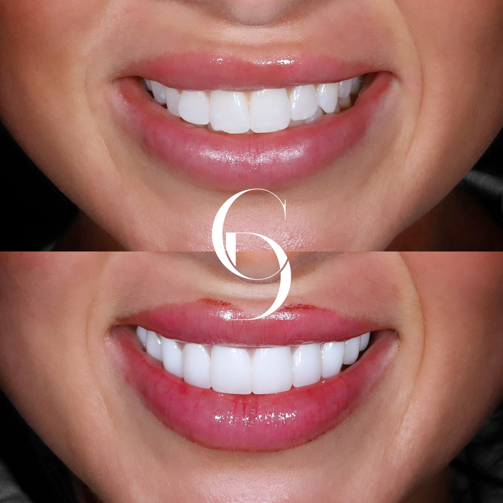 Mia's Veneers Makeover In Cosmetique Dental™