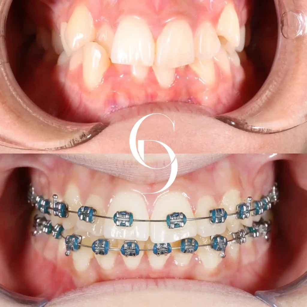 Mia's Orthodontics Treatment In Cosmetique Dental™