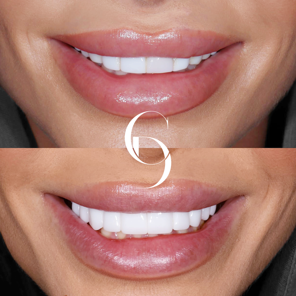 Millie's Veneers Makeover In Cosmetique Dental™