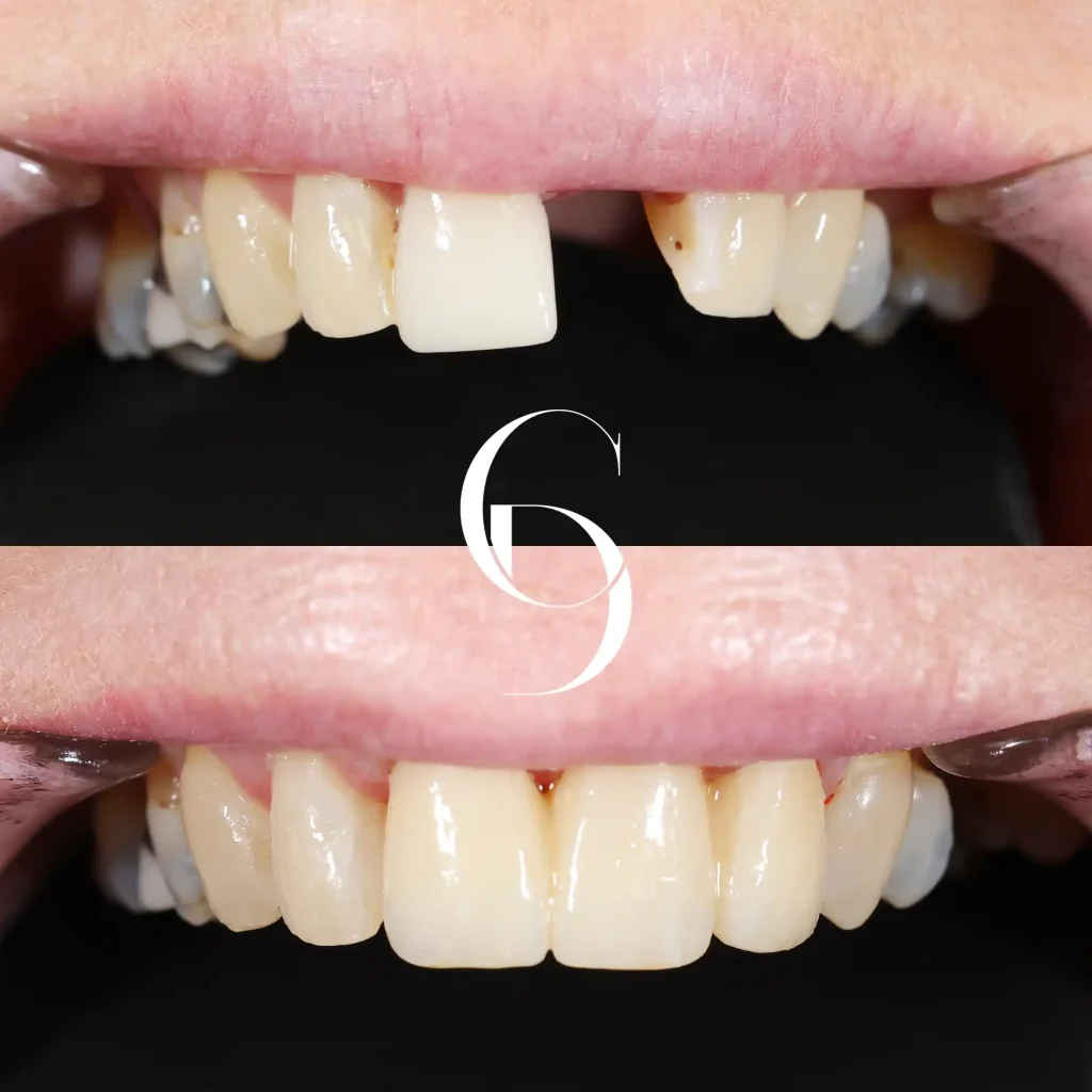 Mill's Dental Implants In Cosmetique Dental™