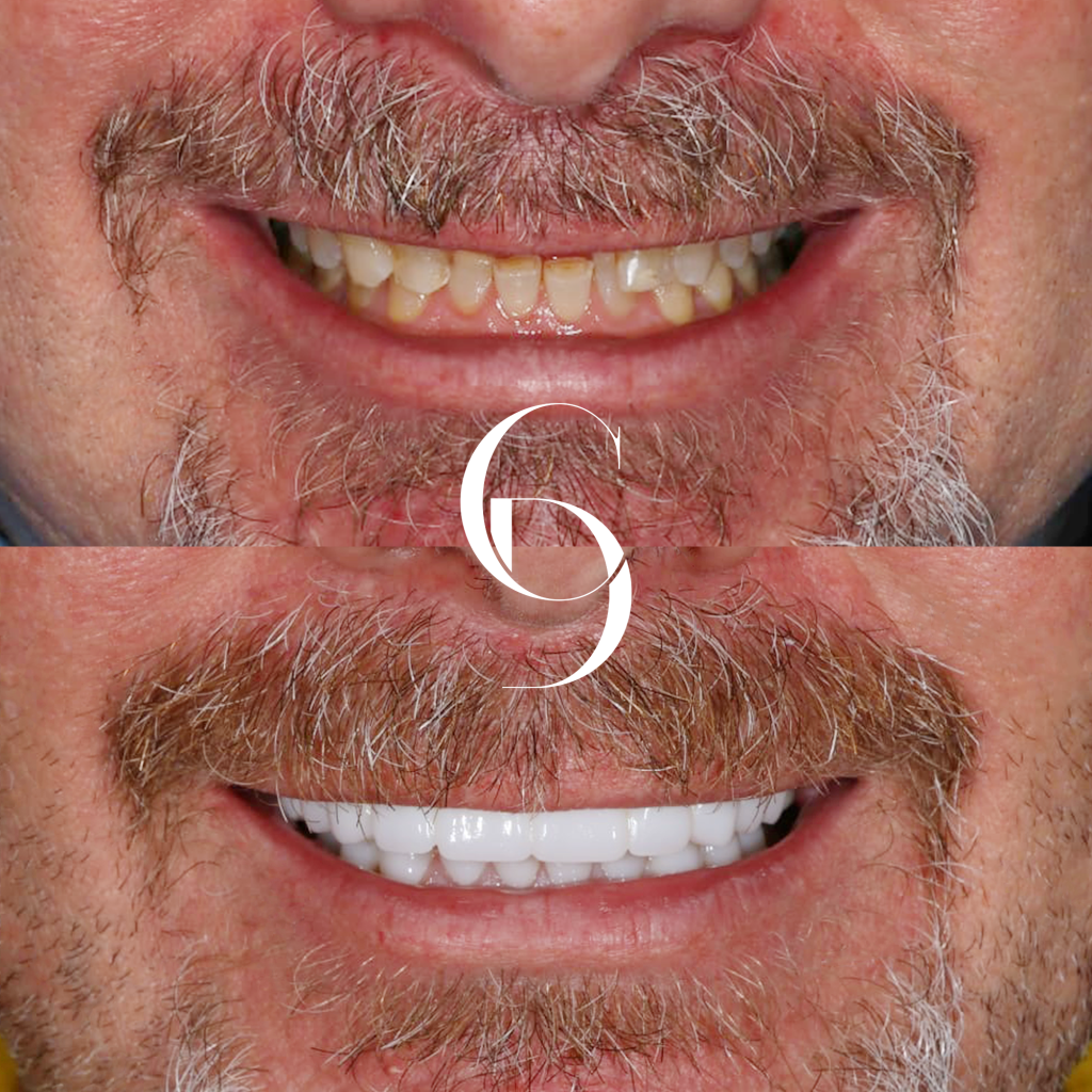 Nate's Veneers Makeover In Cosmetique Dental™