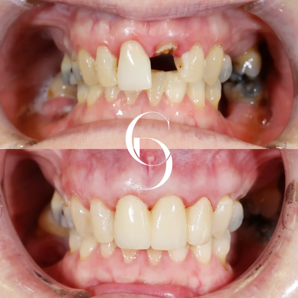 Niall's Dental Implants In Cosmetique Dental™