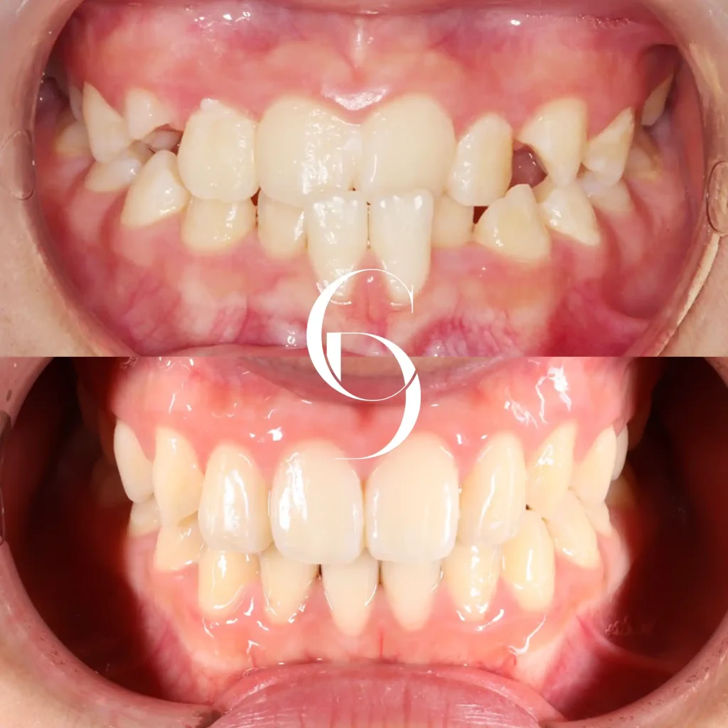 Nia's Orthodontics Treatment In Cosmetique Dental™