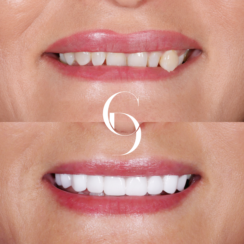 Olivia Veneers Makeover In Cosmetique Dental™ Olivia's Veneers Makeover In Cosmetique Dental™