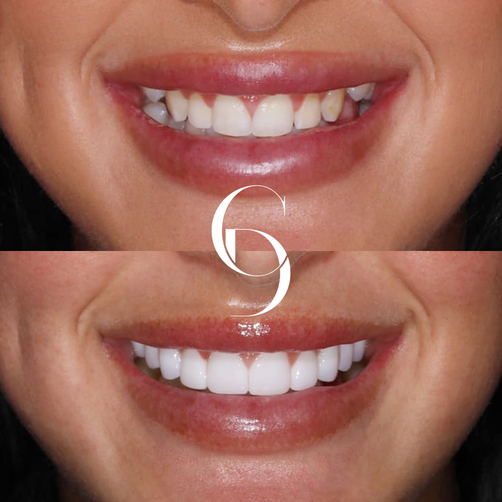 Peyton's Veneers Makeover In Cosmetique Dental™