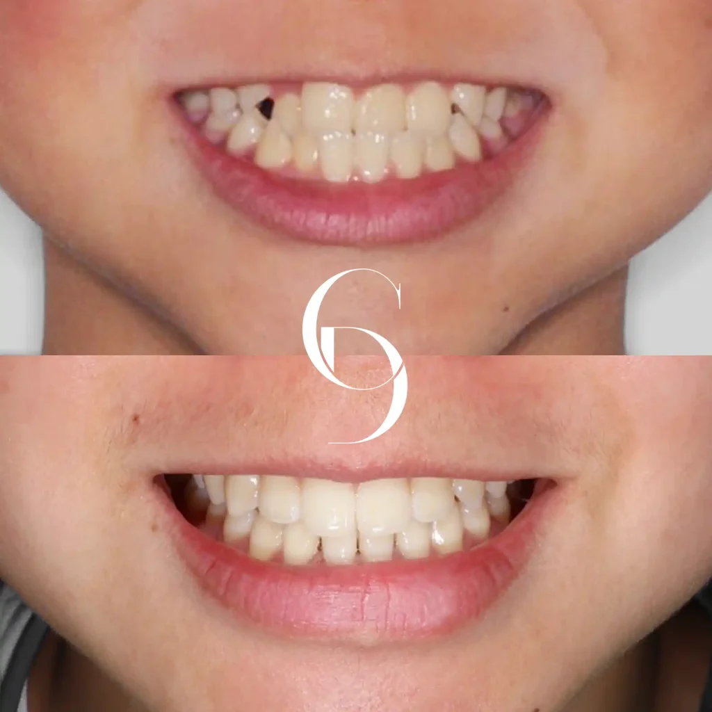 Pia's Orthodontics Treatment In Cosmetique Dental™
