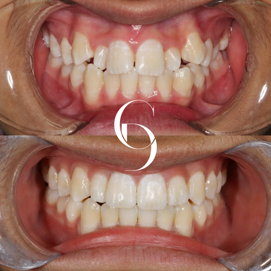 Poppy's Orthodontics Braces Makeover In Cosmetique Dental™