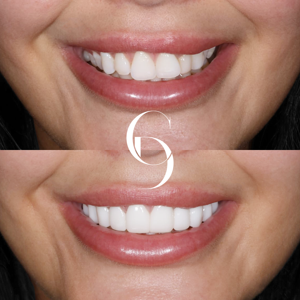 Porcelain & Dental Veneers North Sydney Aleyna's Smile Transformation At Cosmetique Dental™