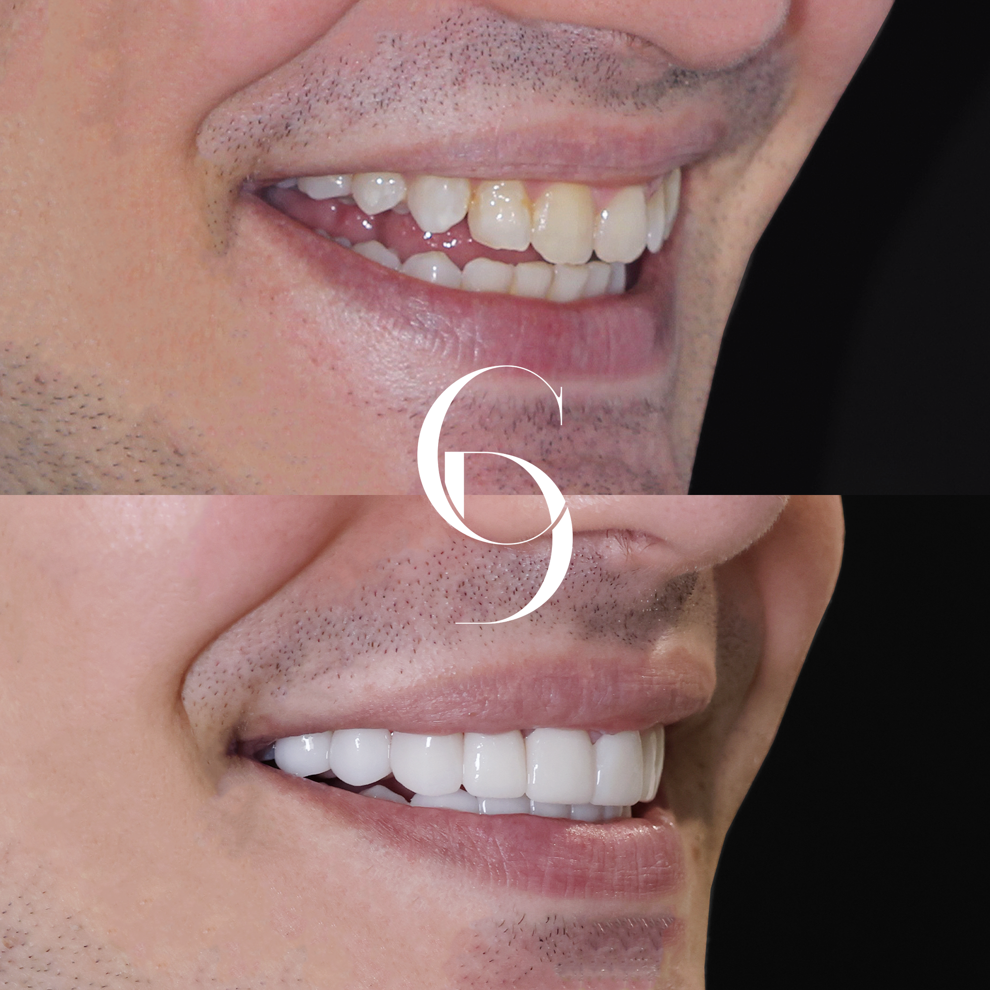 Porcelain Veneers Parramatta Sergio’s Smile Transformation At Cosmetique Dental™
