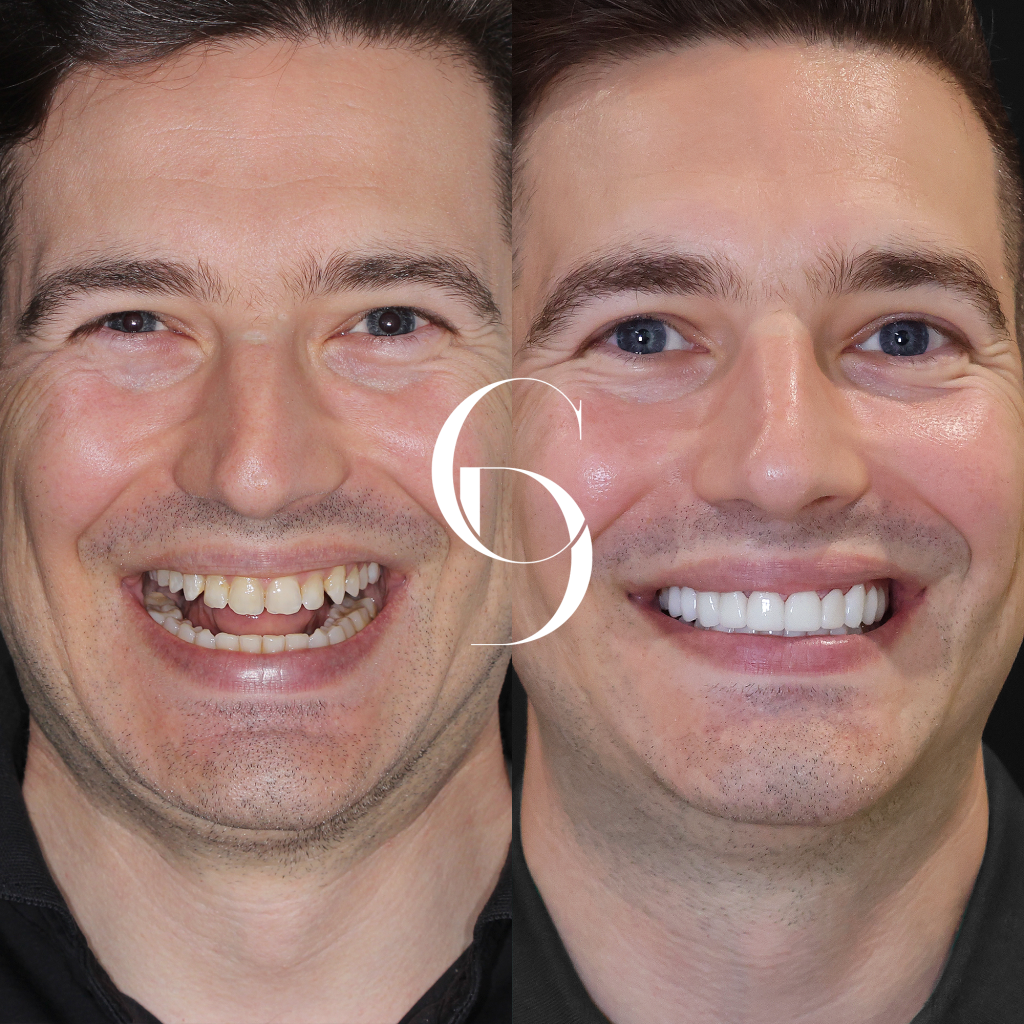 Porcelain Veneers Parramatta Sergio’s Smile Transformation At Cosmetique Dental™