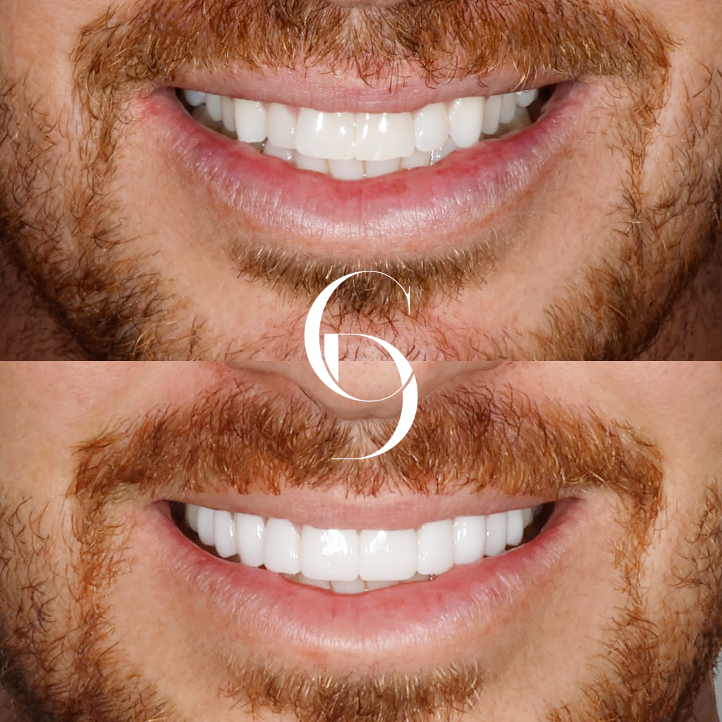 Quinn's Veneers Makeover In Cosmetique Dental™