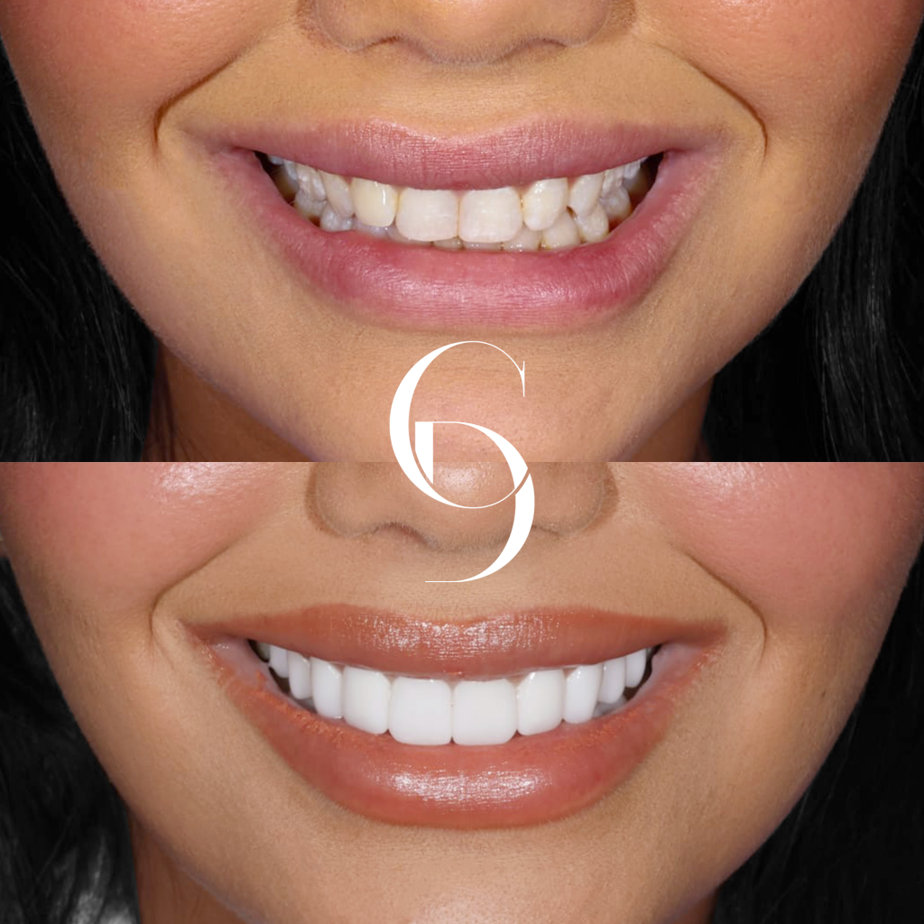 Savannah's Veneers Makeover In Cosmetique Dental™