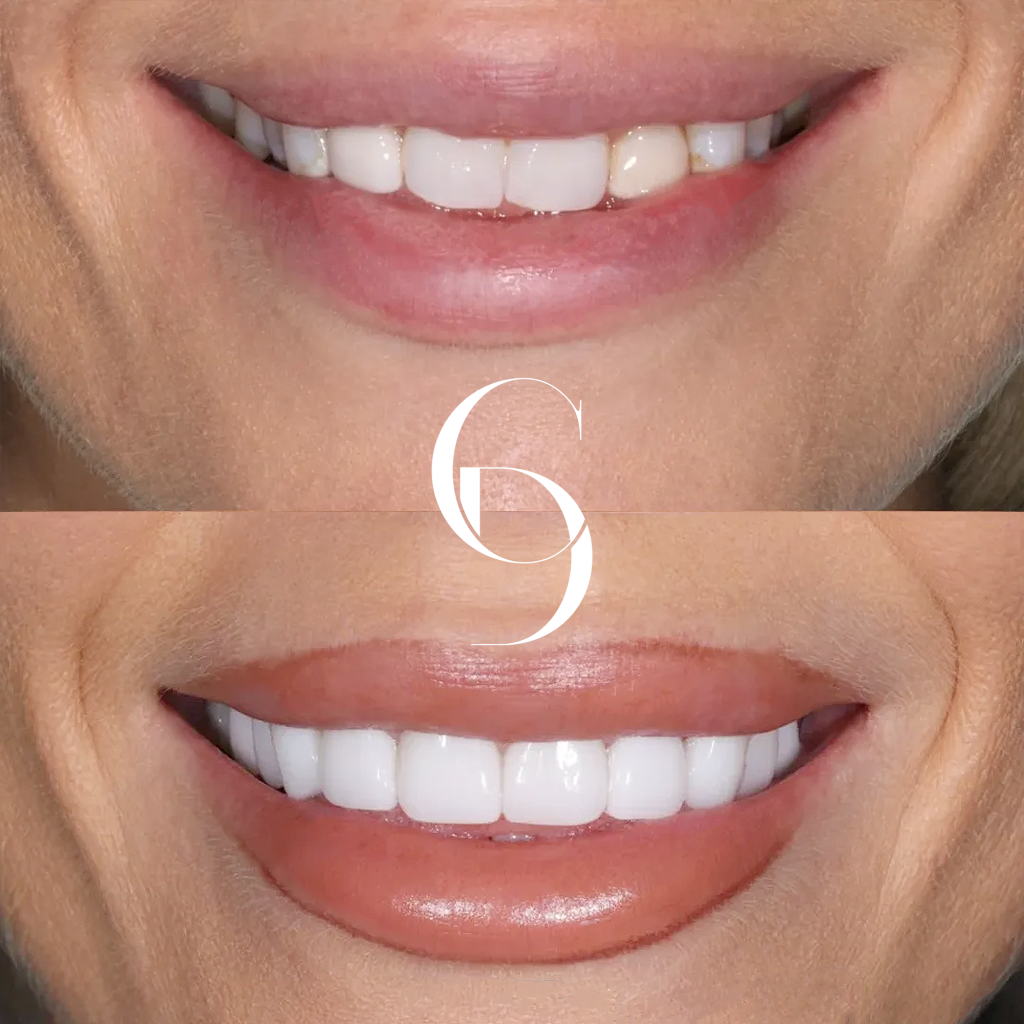 Scarlett's Veneers Makeover In Cosmetique Dental™