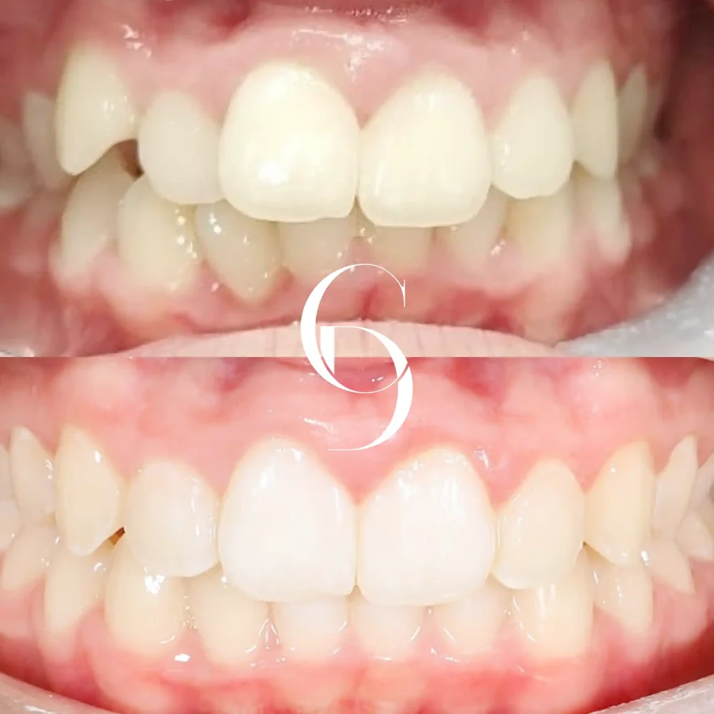 Sia's Orthodontics Makeover In Cosmetique Dental™