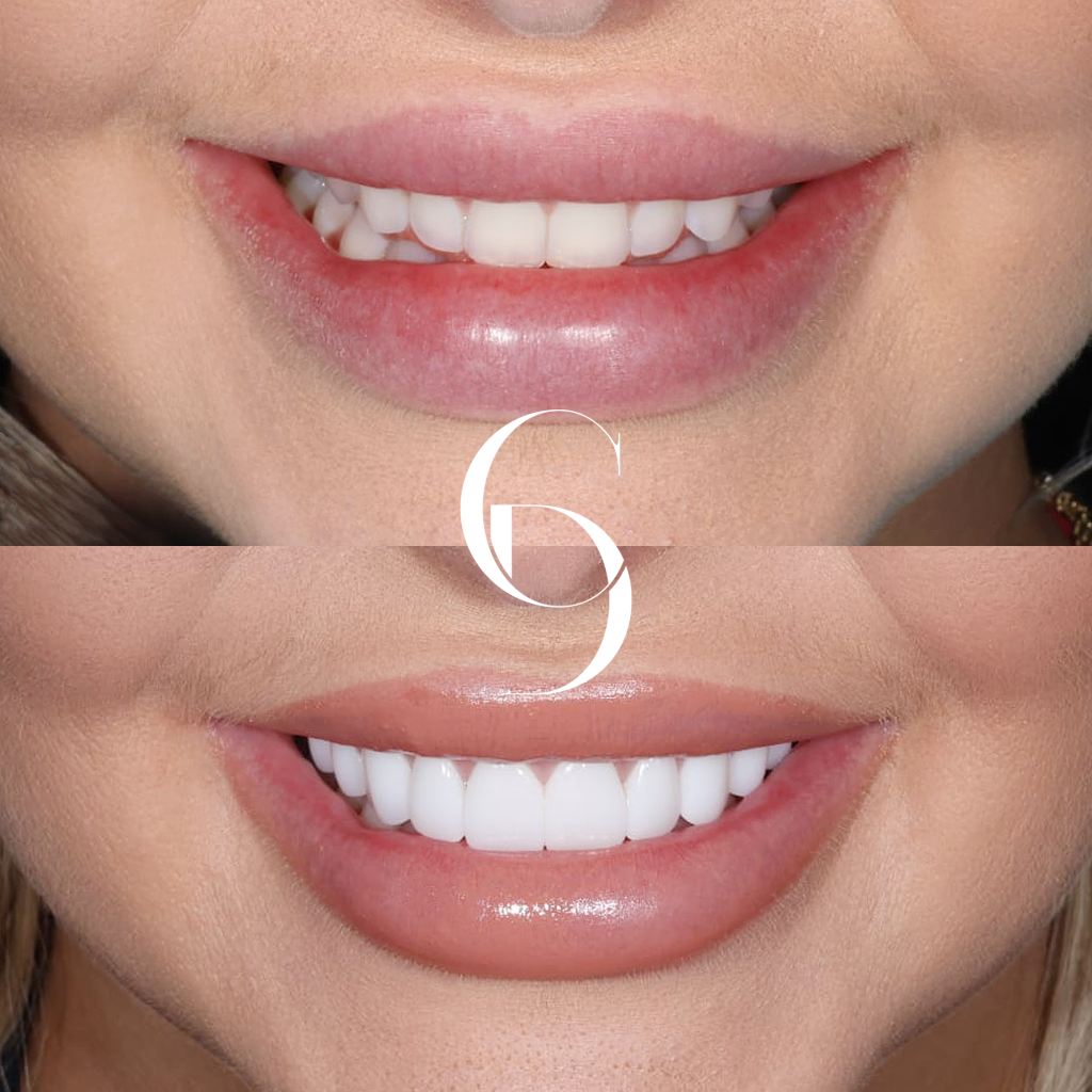 Sienna's Veneers Makeover In Cosmetique Dental™