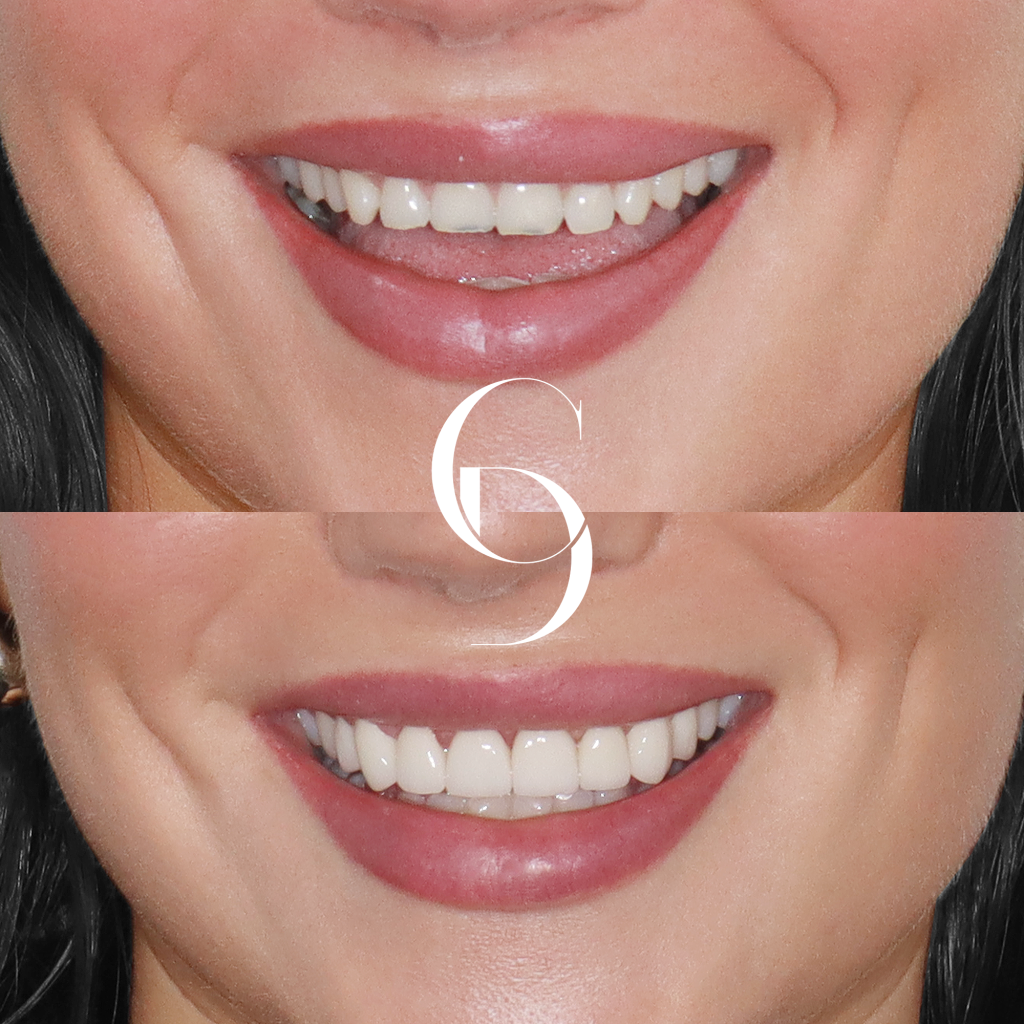 Stella's Veneers Makeover In Cosmetique Dental™