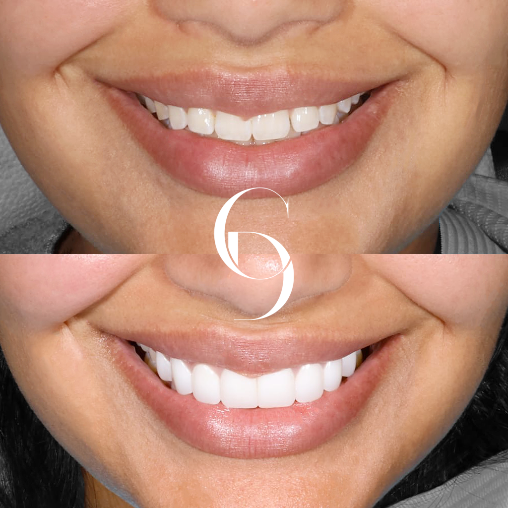 Summer's Veneers Makeover In Cosmetique Dental™