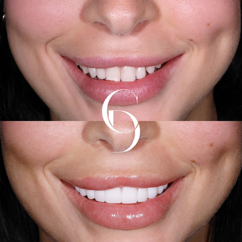 Tahlia's Veneers Makeover In Cosmetique Dental™
