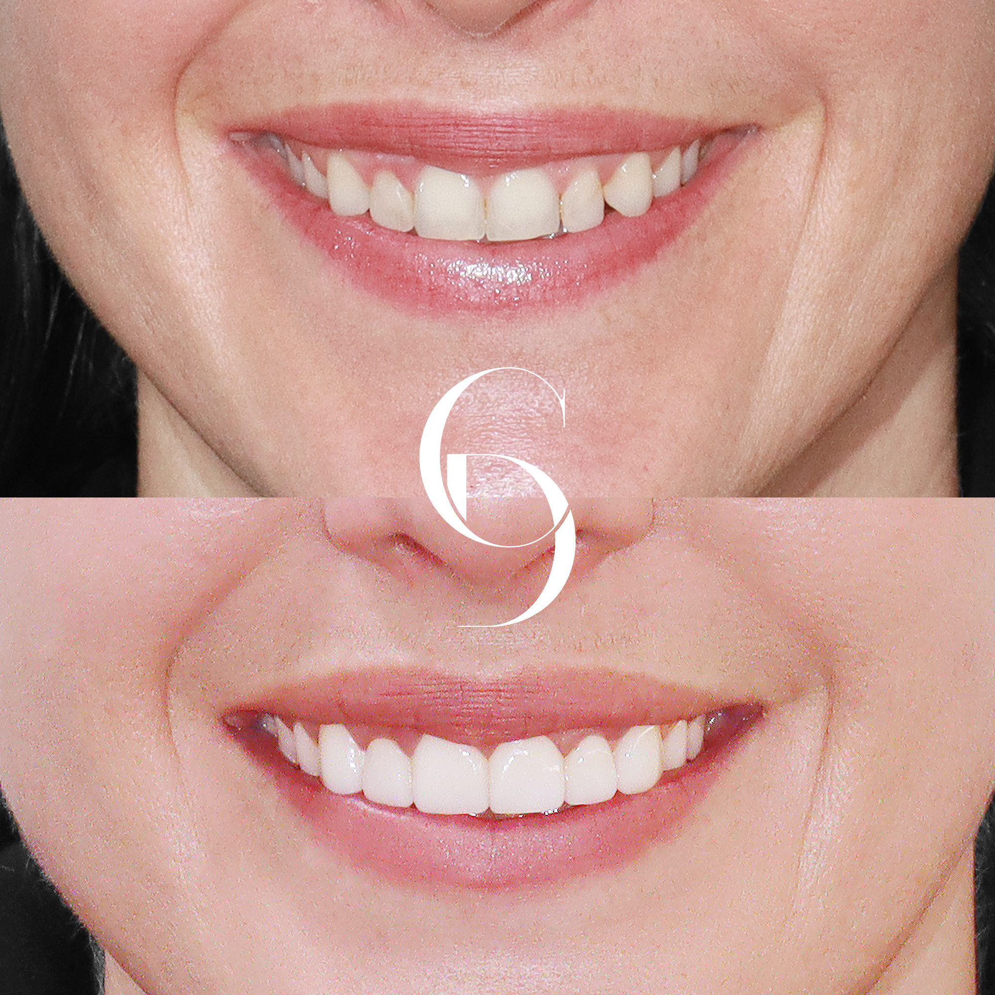Tara's Aesthetic Dental Enhancement with Porcelain Veneers in Sydney CBD