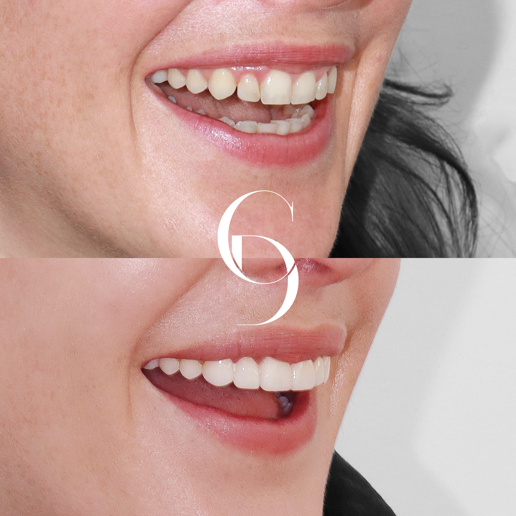 Tara's Aesthetic Dental Enhancement with Porcelain Veneers in Sydney CBD