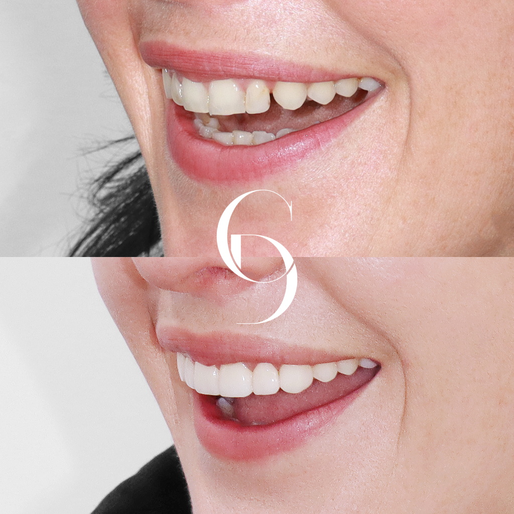 Tara's Aesthetic Dental Enhancement with Porcelain Veneers in Sydney CBD