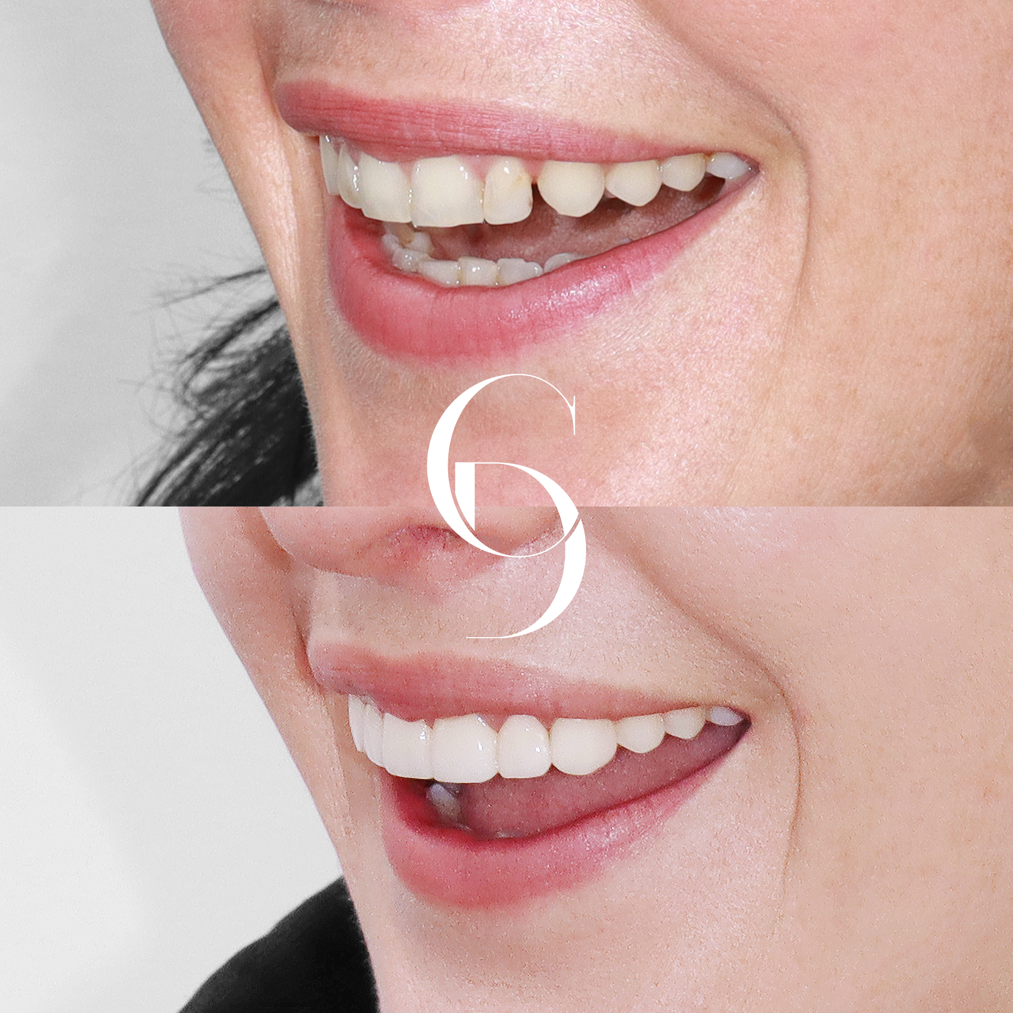 Tara's Aesthetic Dental Enhancement with Porcelain Veneers in Sydney CBD