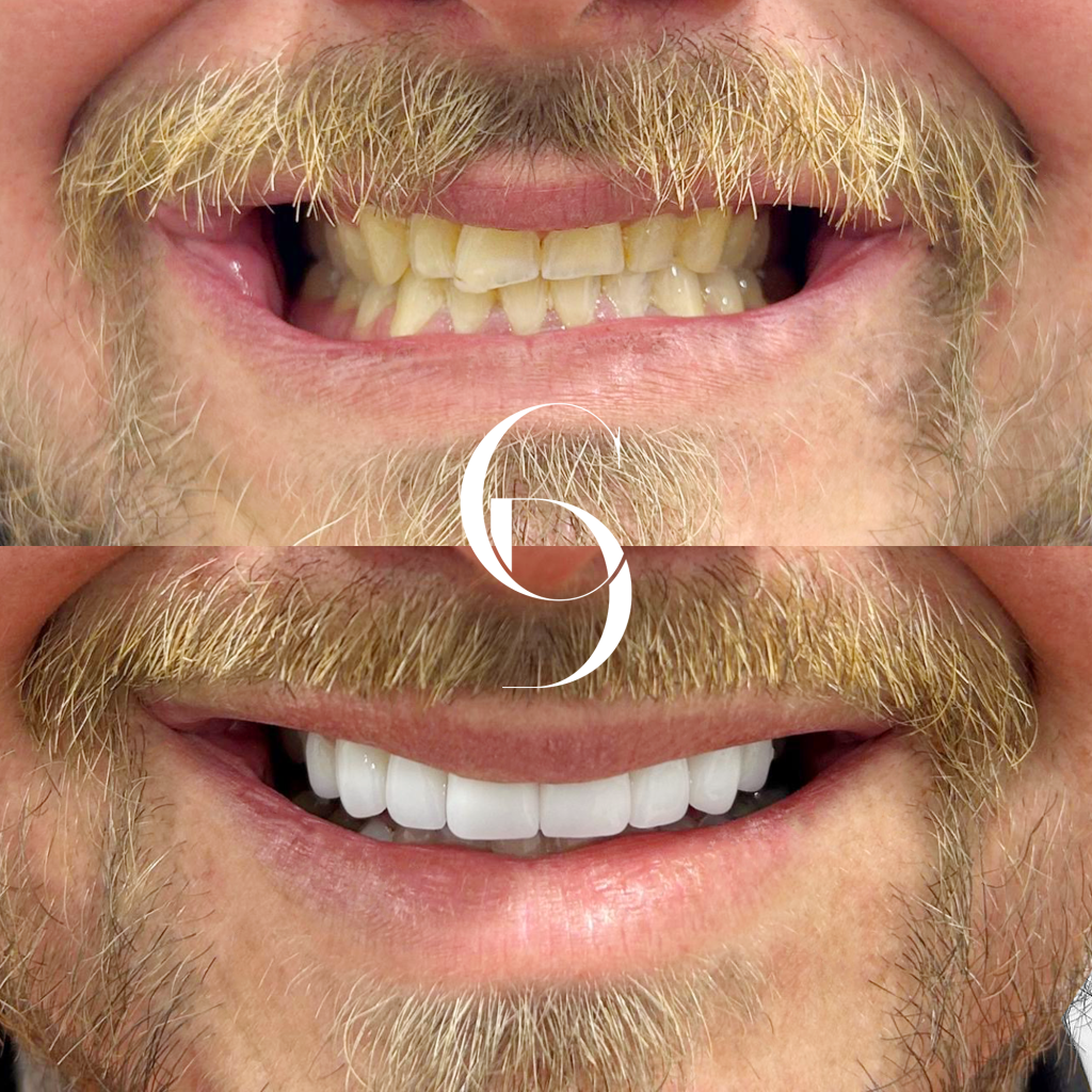 Thomas' Veneers Makeover In Cosmetique Dental™