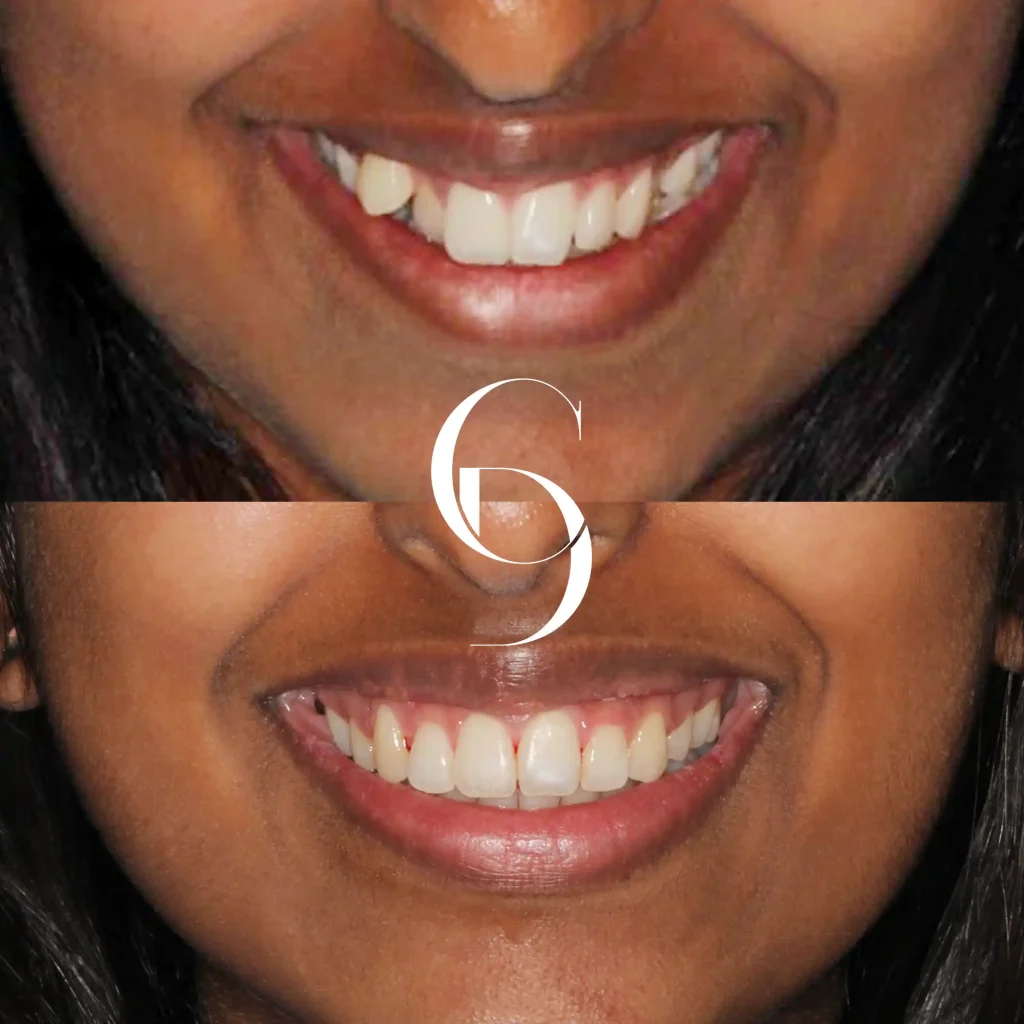 Via's Orthodontics Treatment In Cosmetique Dental™