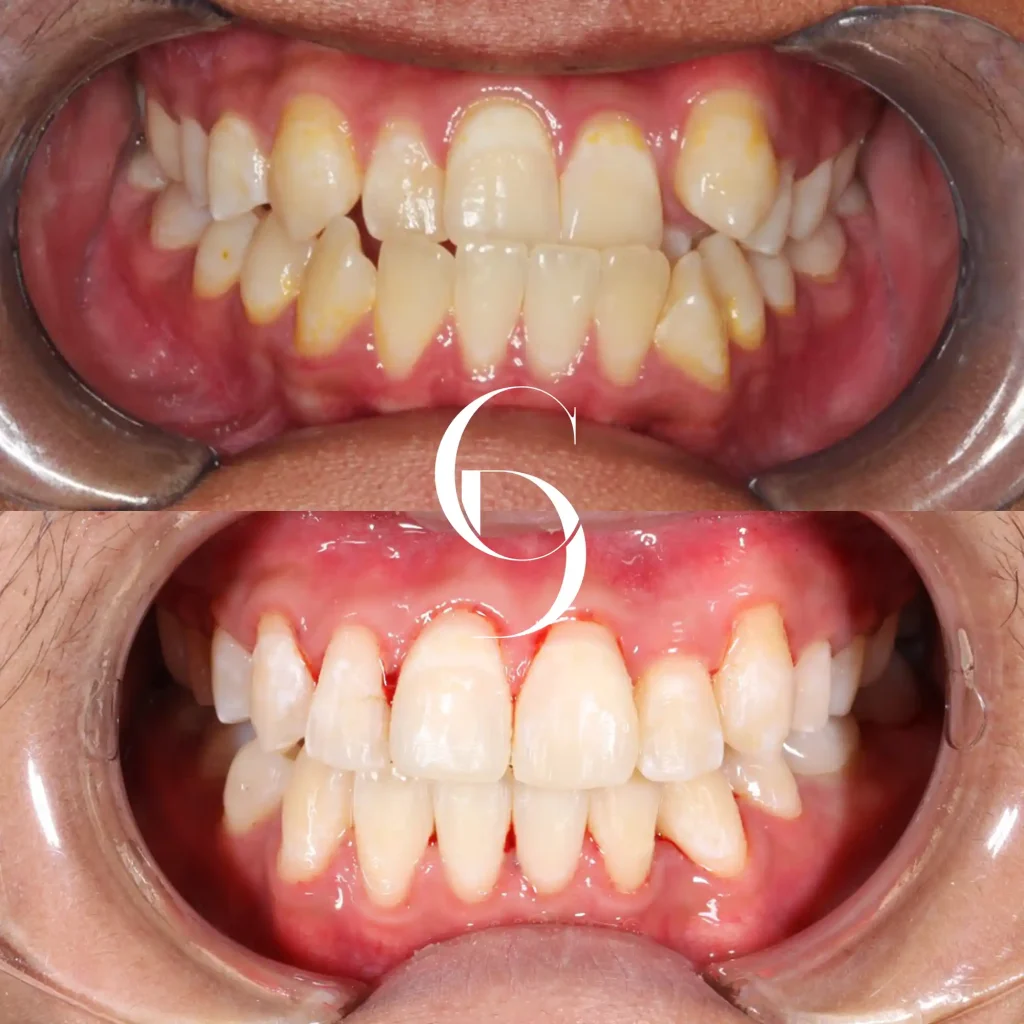 Wia's Orthodontics Makeover In Cosmetique Dental™