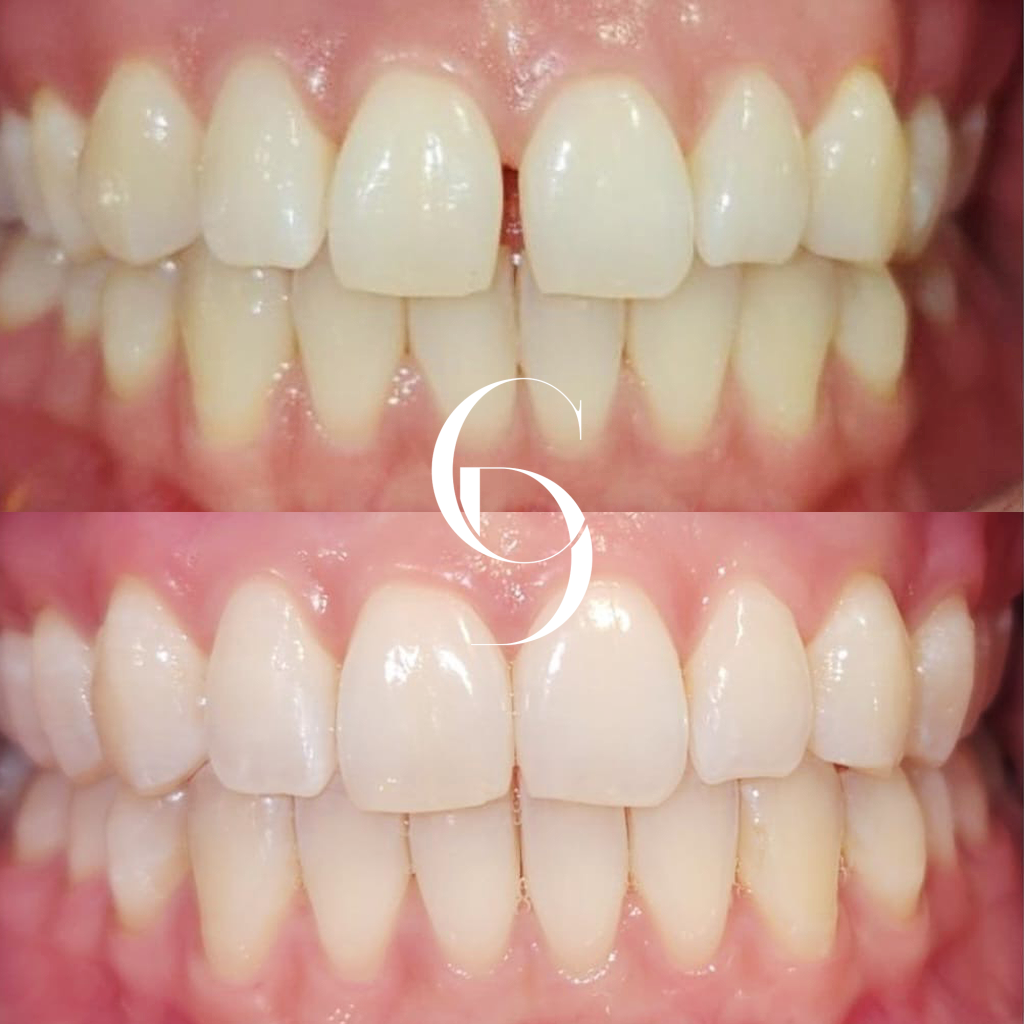 Willow's Invisalign Makeover In Cosmetique Dental™