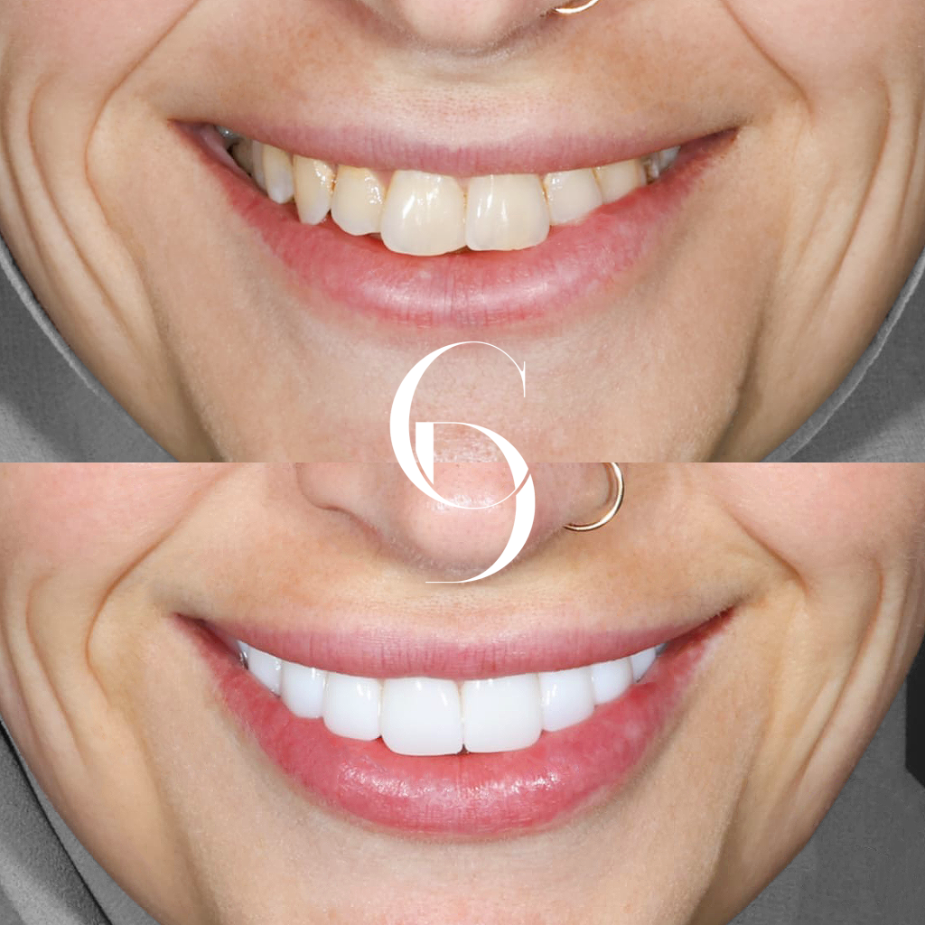 Zara's Veneers Makeover In Cosmetique Dental™