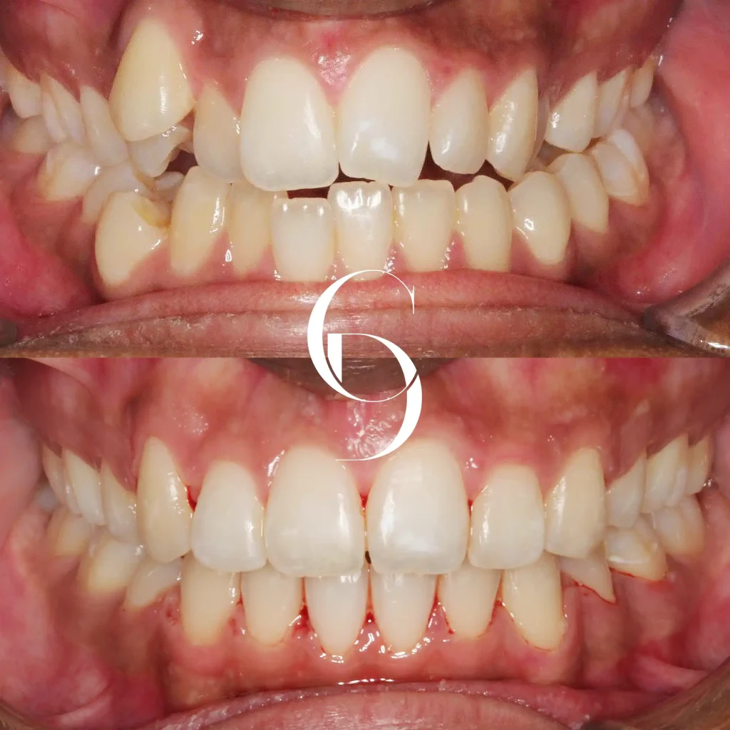 Zia's Orthodontics Makeover In Cosmetique Dental™