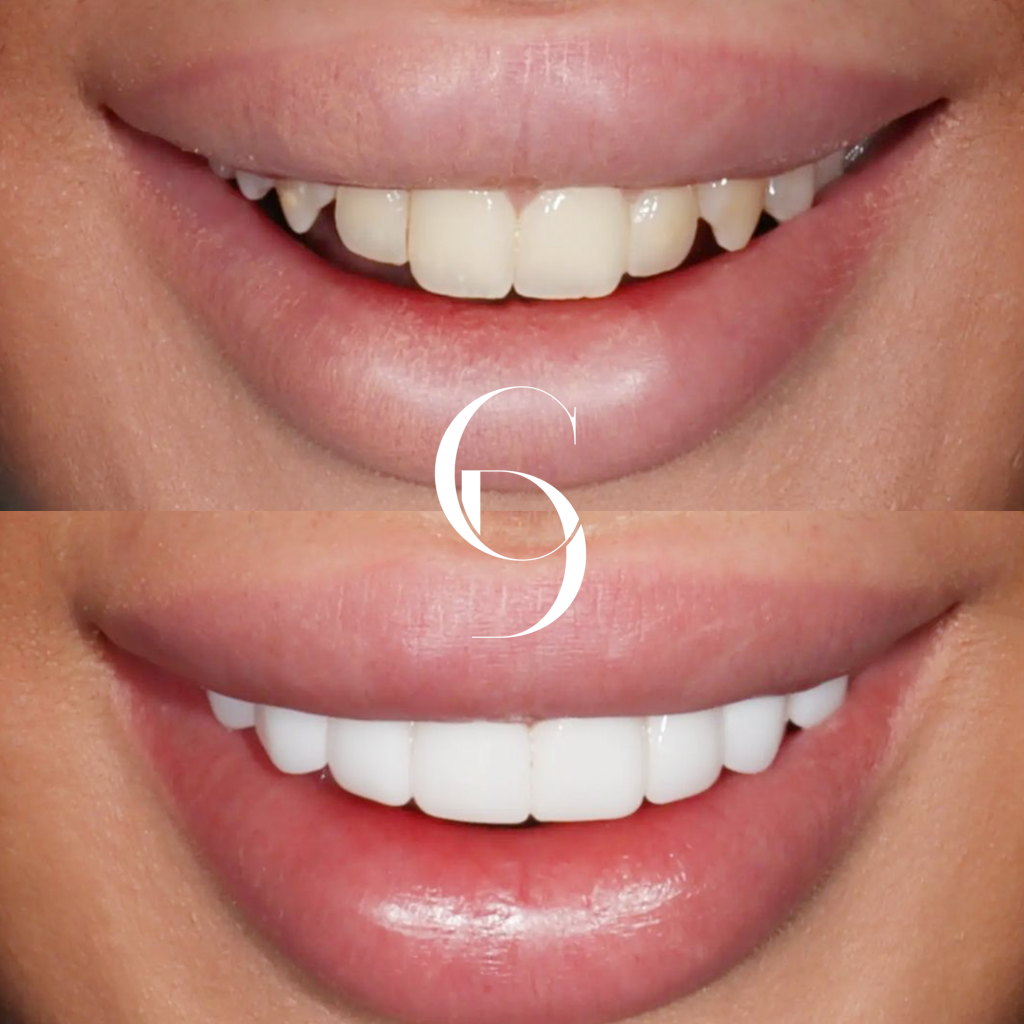 Zoe's Veneers Makeover In Cosmetique Dental™