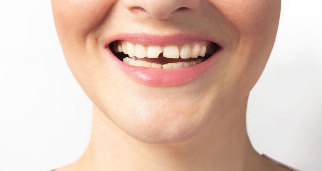 Broken Tooth Repair In Cosmetique Dental