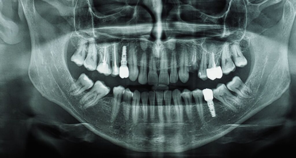 Dental Implant Aftercare In Cosmetique Dental
