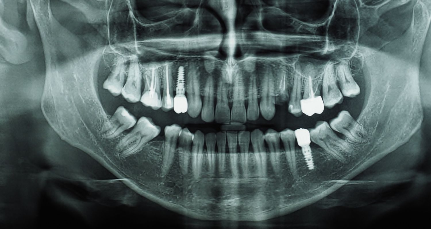 Dental Implant Aftercare In Cosmetique Dental