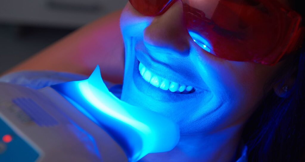 Professional Whitening Or DIY Kits In Cosmetique Dental