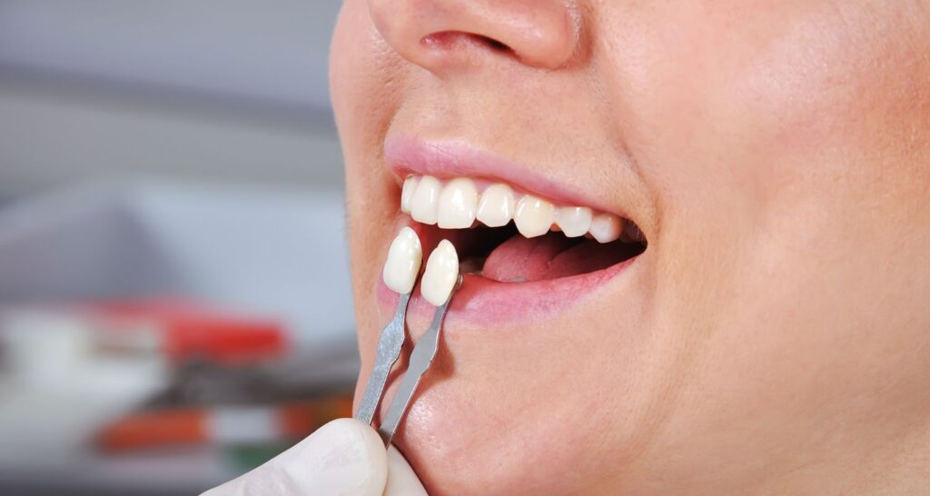 The Complete Guide To Dental Veneers In Sydney Cosmetique Dental