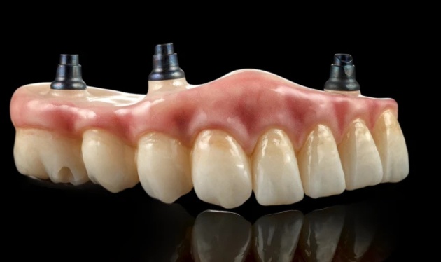 All-Teeth-on-Implants at Cosmetique Dental