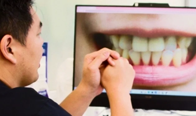 Gum Contouring at Cosmetique Dental
