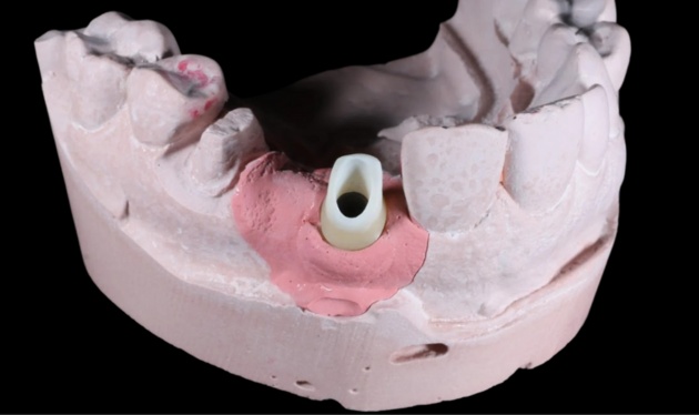 Restorative Dentistry in Sydney & Canberra