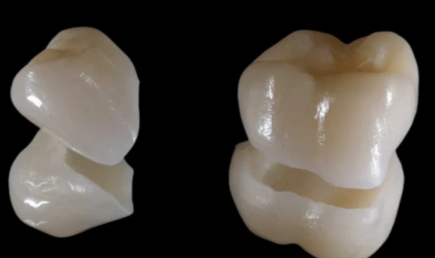 Porcelain Crowns in Sydney and Canberra